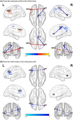 Disrupted Causal Connectivity Anchored on the Right Anterior Insula in Drug-Naive First-Episode Patients With Depressive Disorder